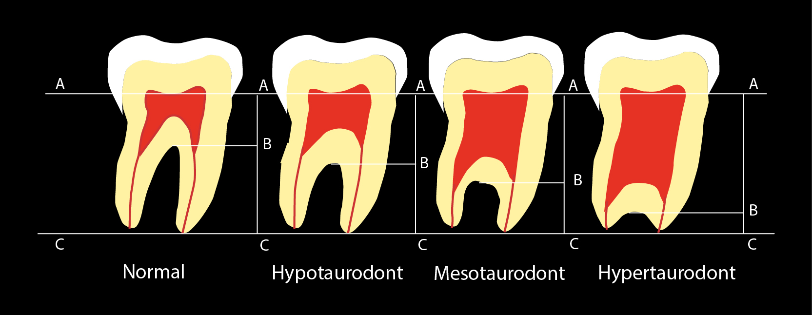 taurodont molar classification